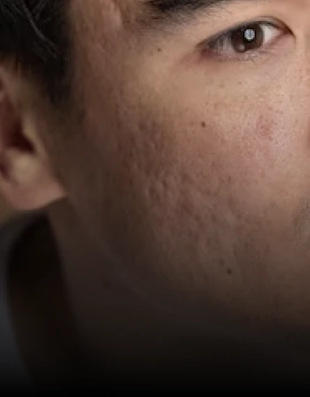 Conditions treated with microneedling