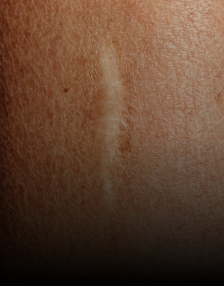 Conditions treated with microneedling