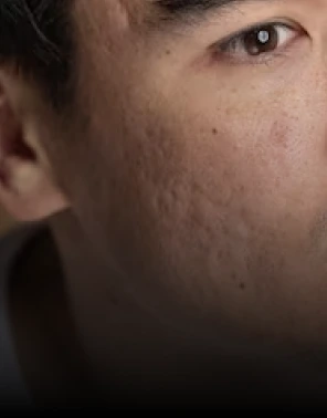 About Acne Scars Banner