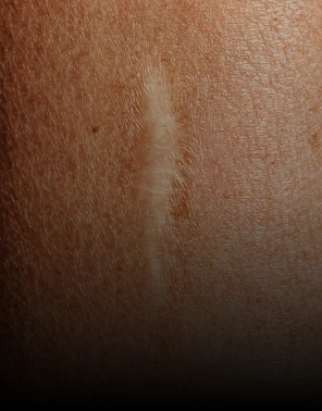 About Scars banner