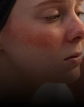 Rosacea Banner