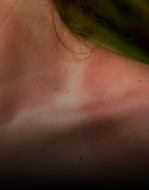 Sun damage Banner