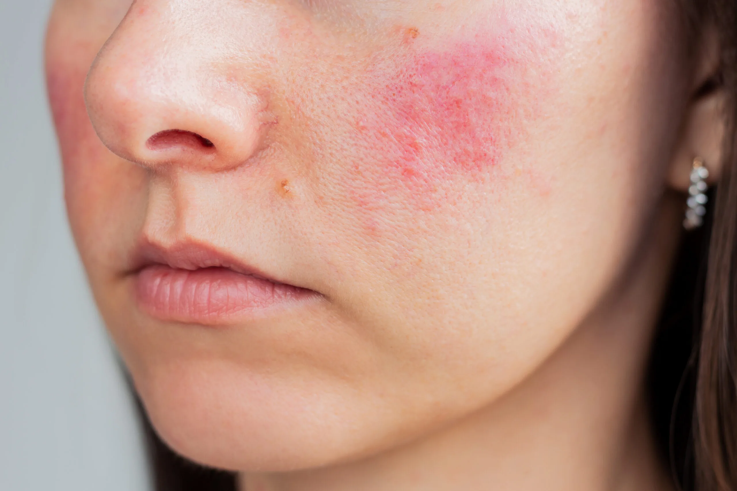 Rosacea Banner