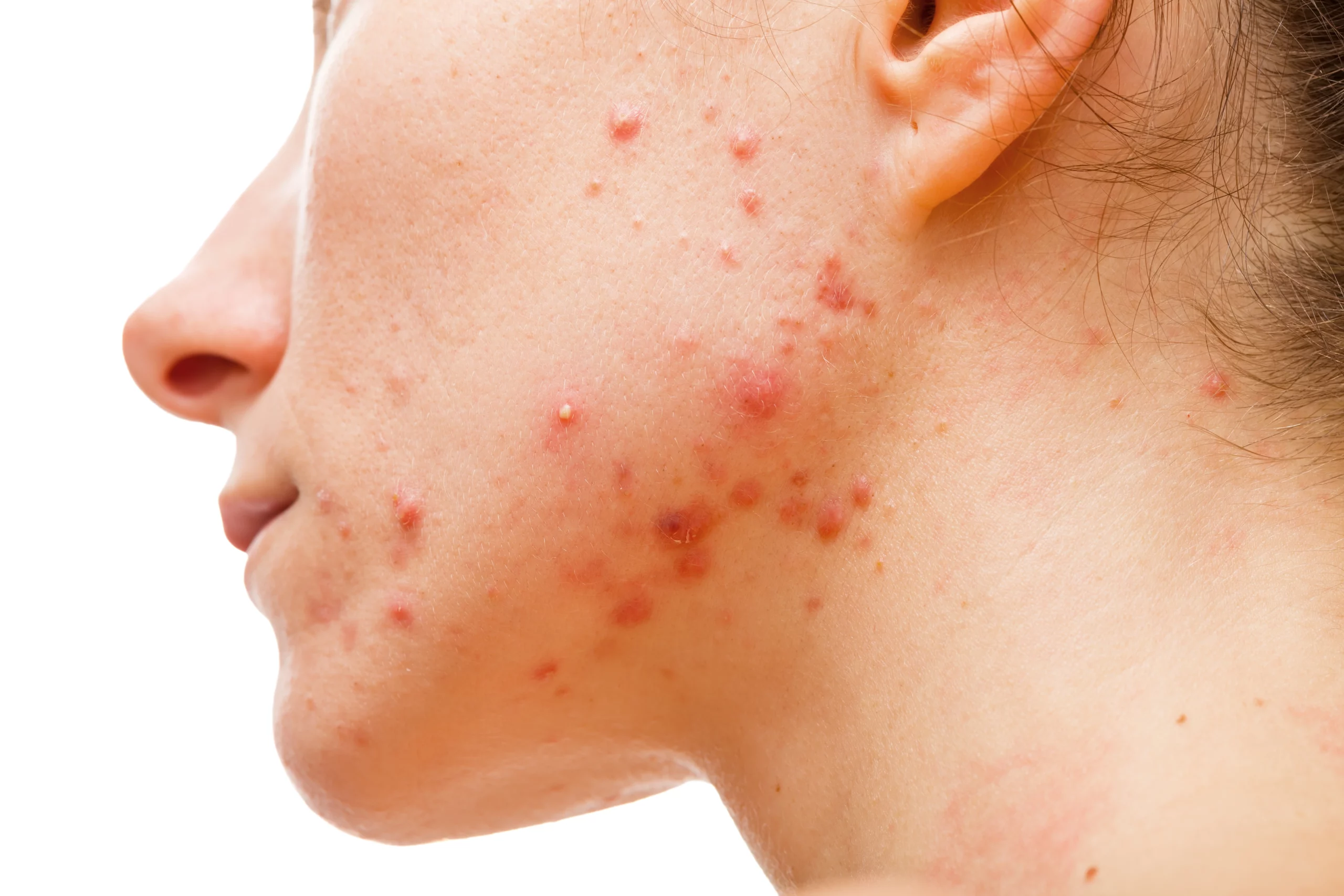 Acne Scars Banner