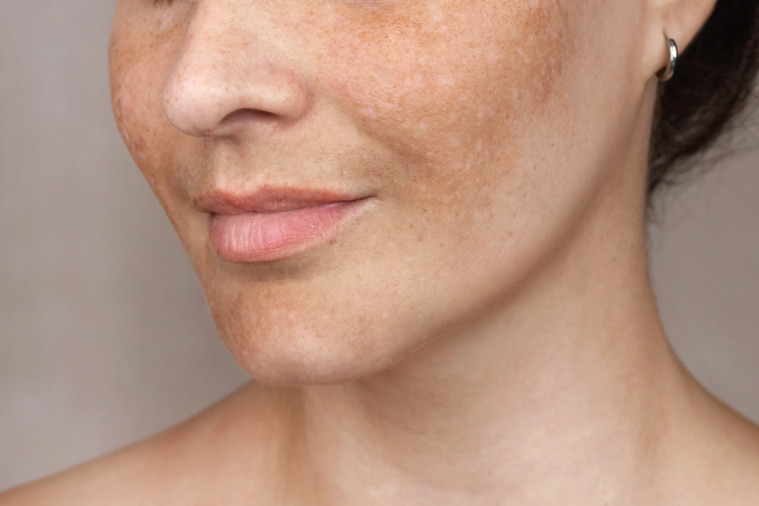 Hyperpigmentation Banner