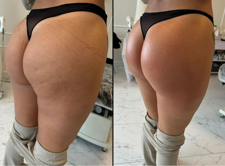 T-Shape 2 Treatment Before and After Gallery