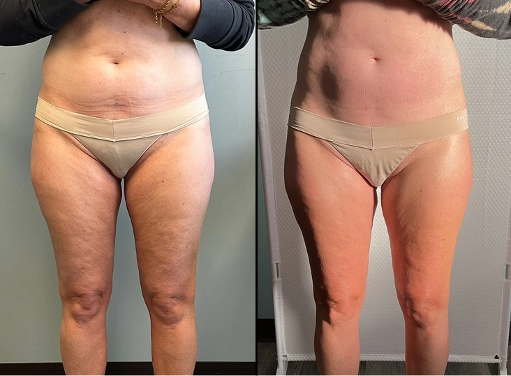 T-Shape 2 Treatment Before and After Gallery