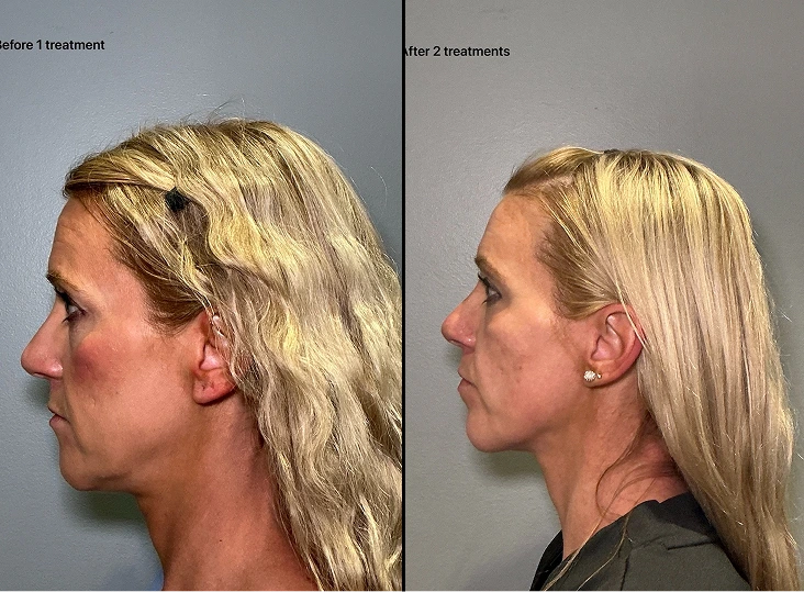 T-Shape 2 Treatment Before and After Gallery