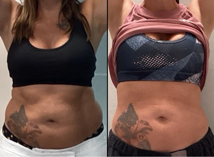 T-Shape 2 Treatment Before and After Gallery