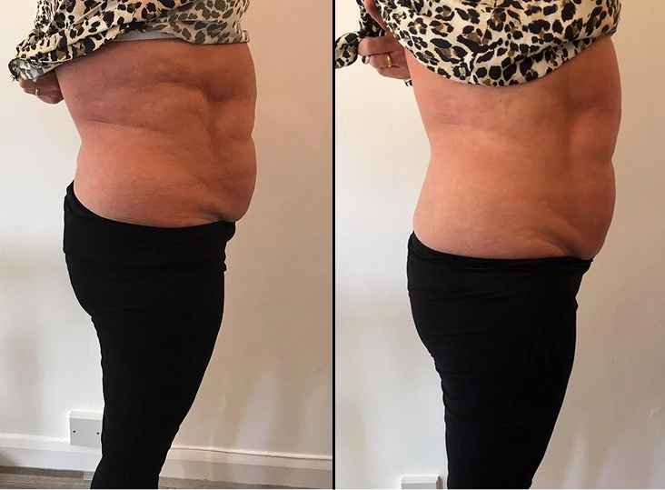 T-Shape 2 Treatment Before and After Gallery