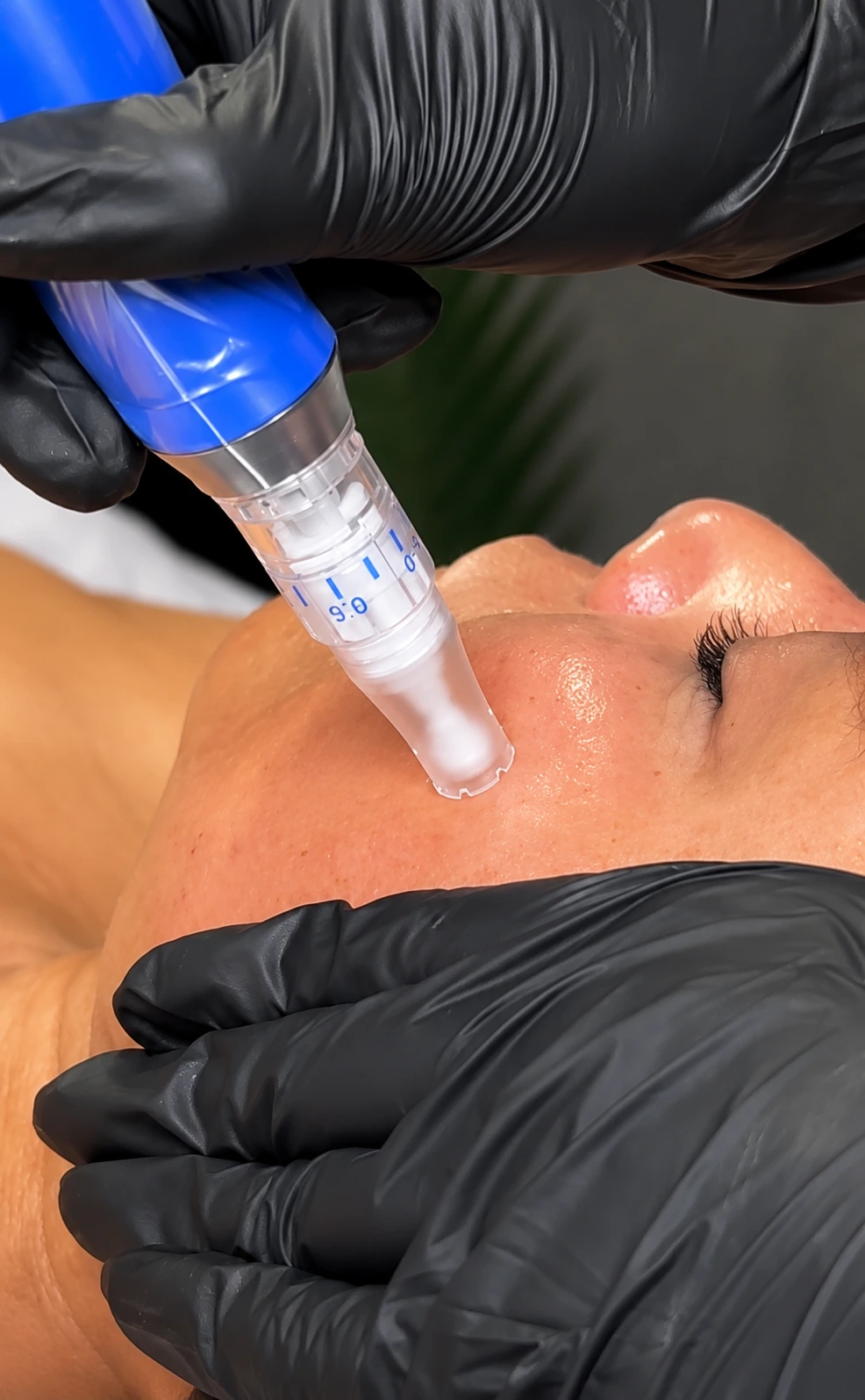 Gloved provider performing microneedling on a woman's face with a pen device